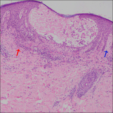 Erythema Multiforme Like Reaction Following Covid Vaccination