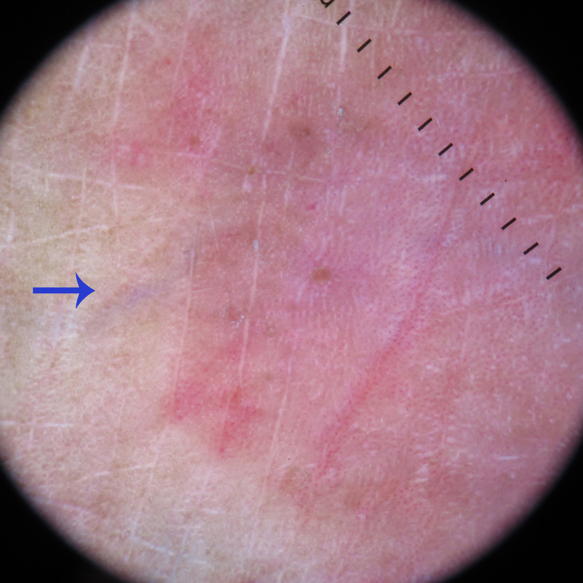 Clinico Dermoscopic And Pathological Features Of A Rare Presentation Of