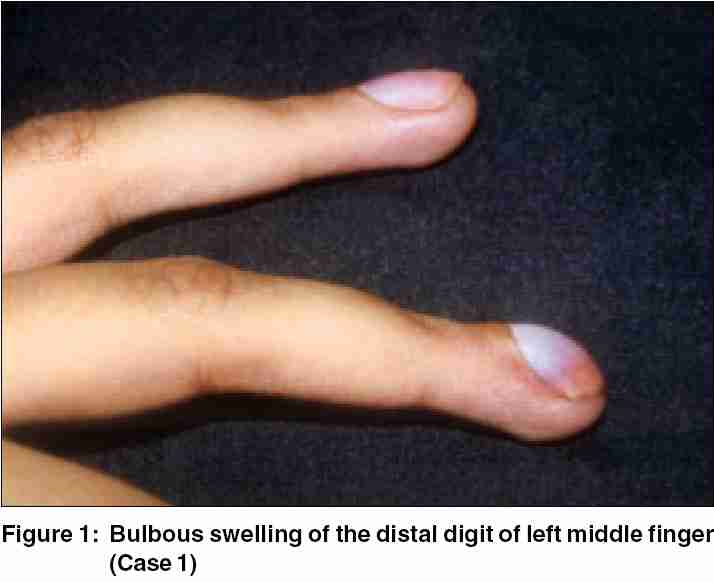 the treatment of glomus finger
