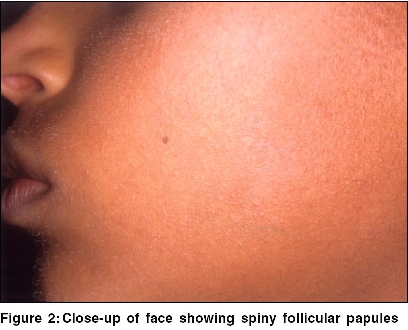 follicular hyperkeratosis face