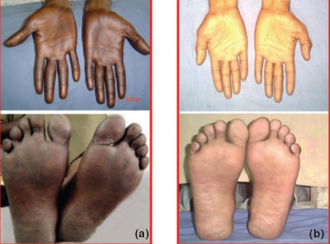 Reversible hyperpigmentation as the first manifestation of dietary vitamin  B12 deficiency - Indian Journal of Dermatology, Venereology and Leprology