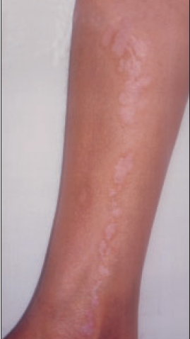 linear psoriasis