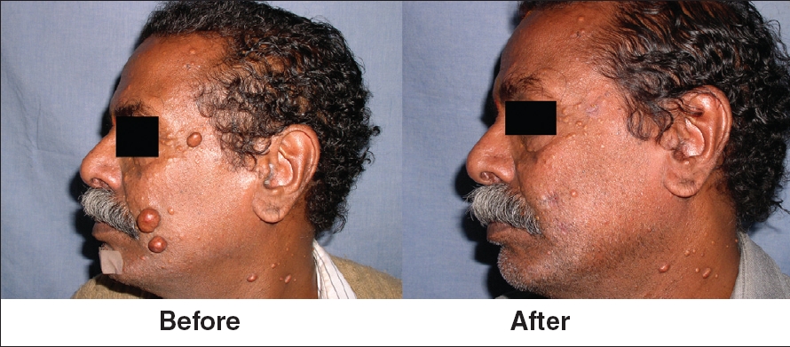Multiple Dermatofibromas On Face Treated With Carbon Dioxide Laser