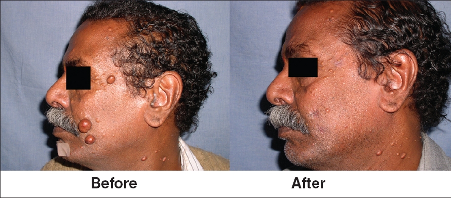 Multiple dermatofibromas on face treated with carbon dioxide laser ...