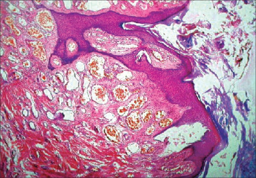 verrucous hemangioma