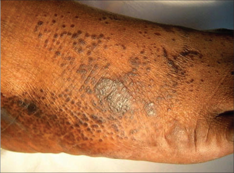 Hyperkeratosis