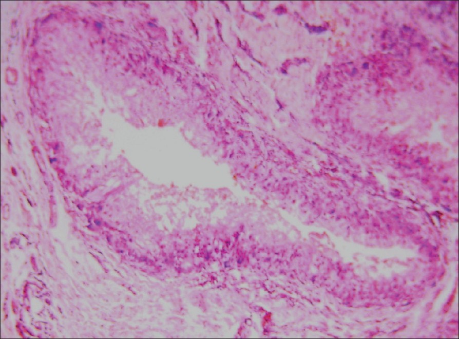 Multiple Asymptomatic Nodules In A Middle Aged Patient Indian Journal