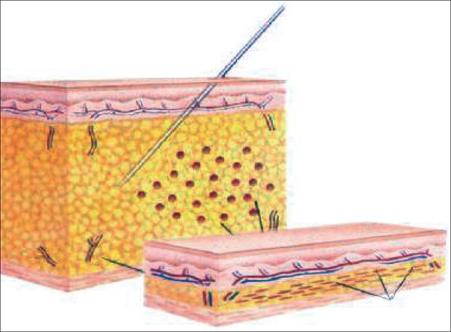 Microcannular tumescent liposuction - Indian Journal of