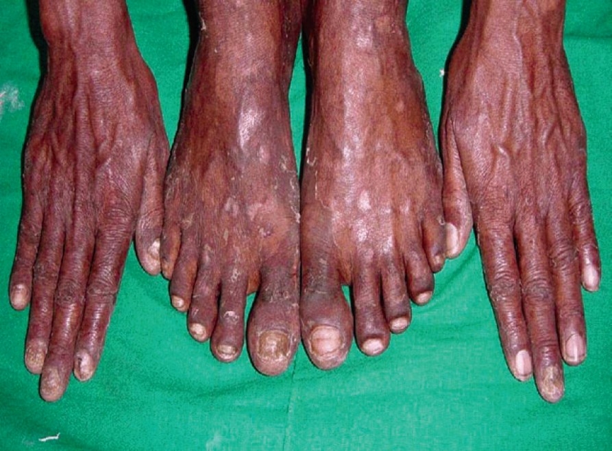 Nail dermatophytoma in HIVinfected patients in Cali Colombia   ScienceDirect