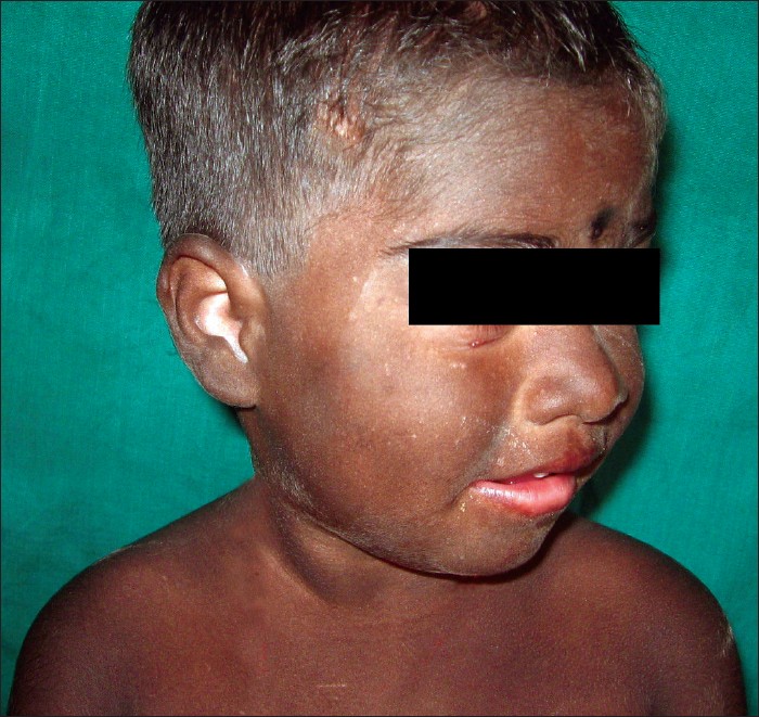 Diffuse Melanosis Cutis