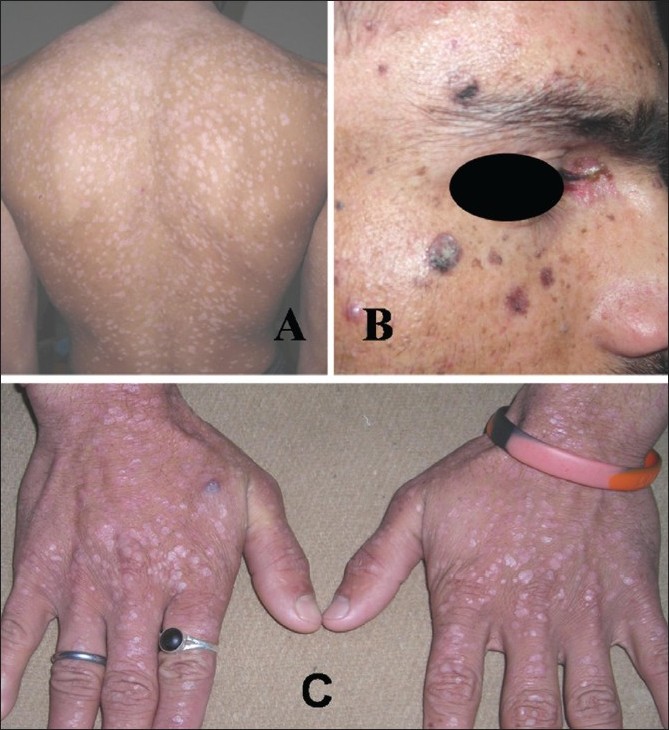 Epidermodysplasia Verruciformis