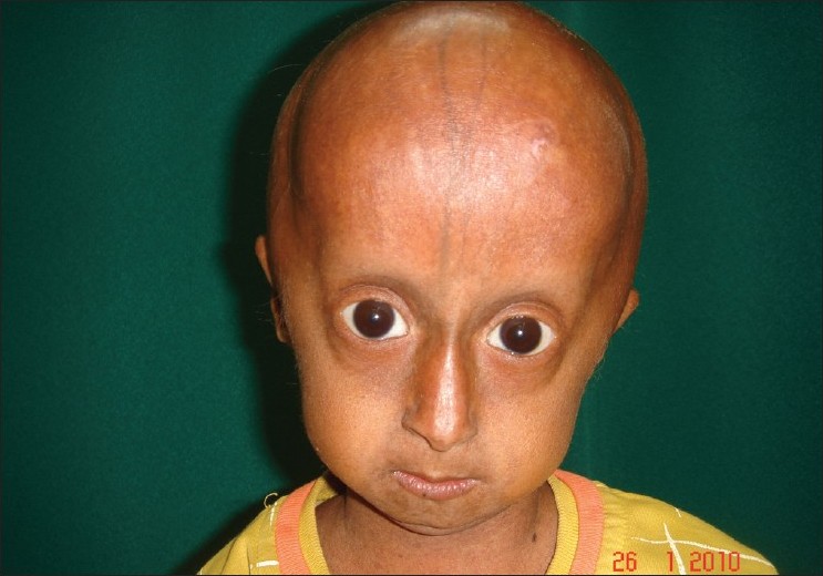 progeria syndrome babies