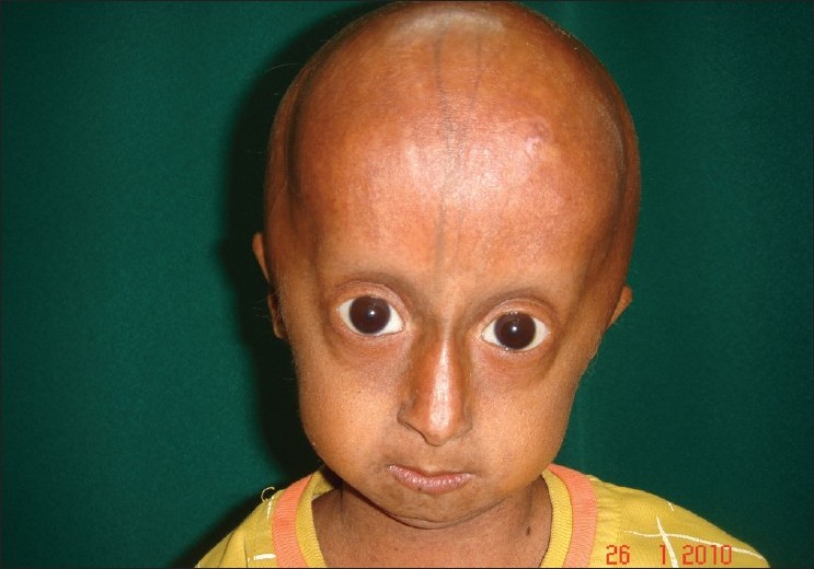 progeria chromosome