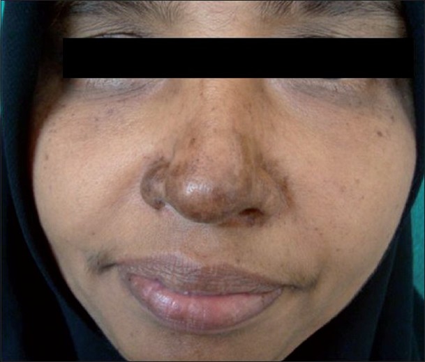 Chikungunya Face Rash