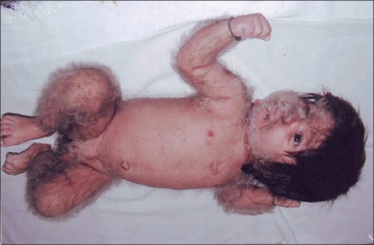 hypertrichosis baby