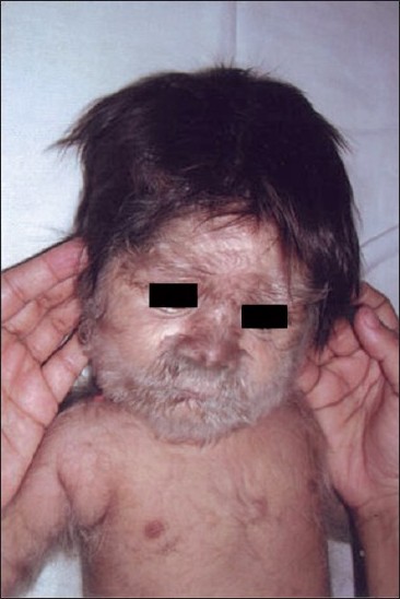 hypertrichosis baby