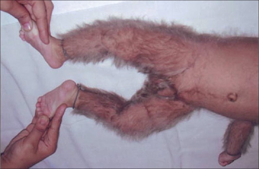 congenital hypertrichosis universalis