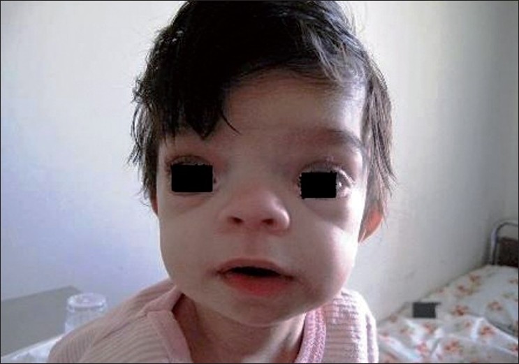 apert syndrome newborn