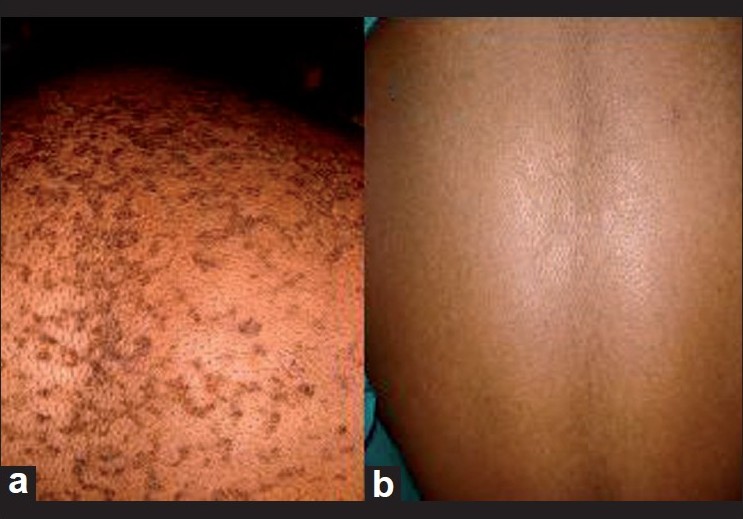 minocycline dose for confluent and reticulated papillomatosis)