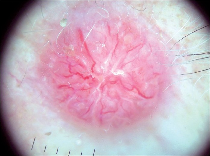 clear cell acanthoma dermoscopy