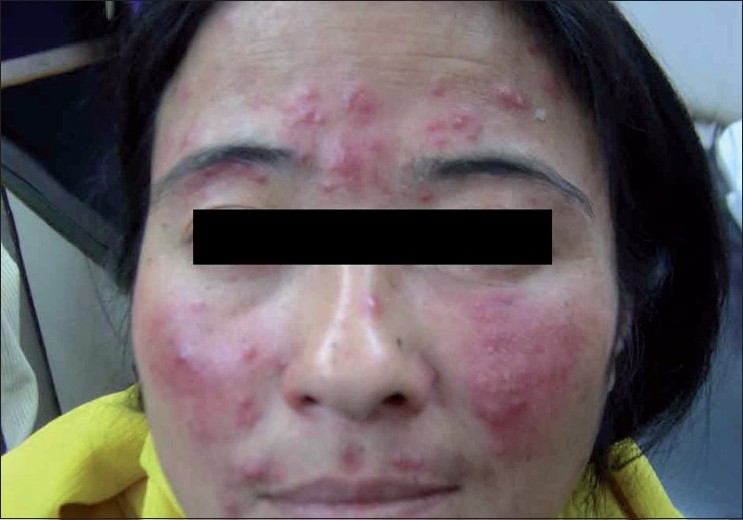 steroid rosacea