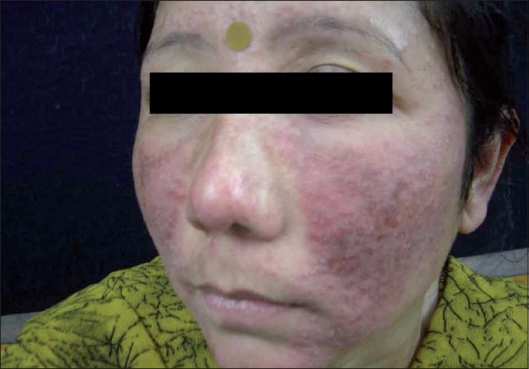 steroid rosacea