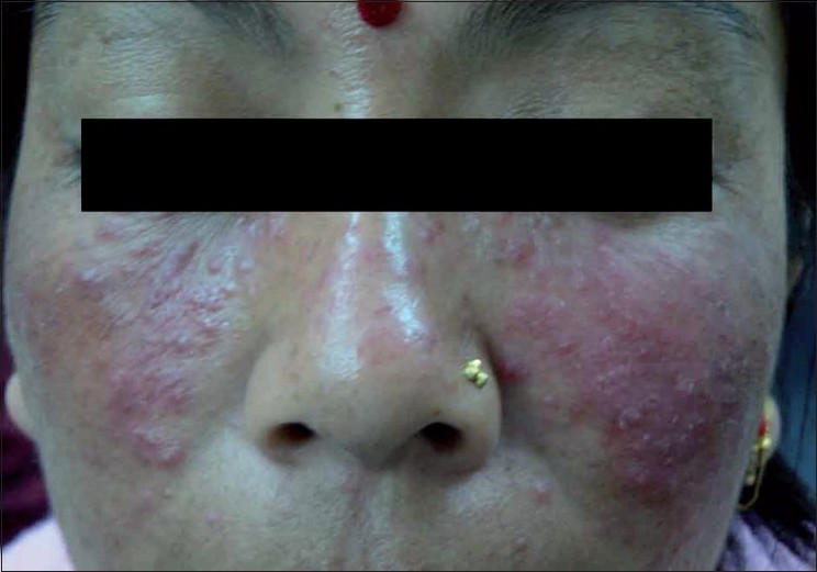 steroid rosacea