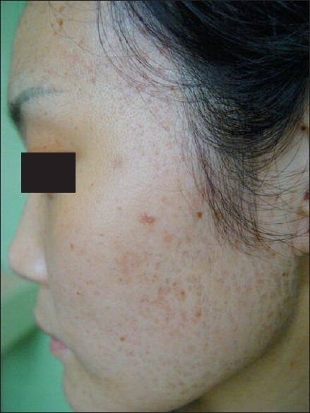 follicular hyperkeratosis face