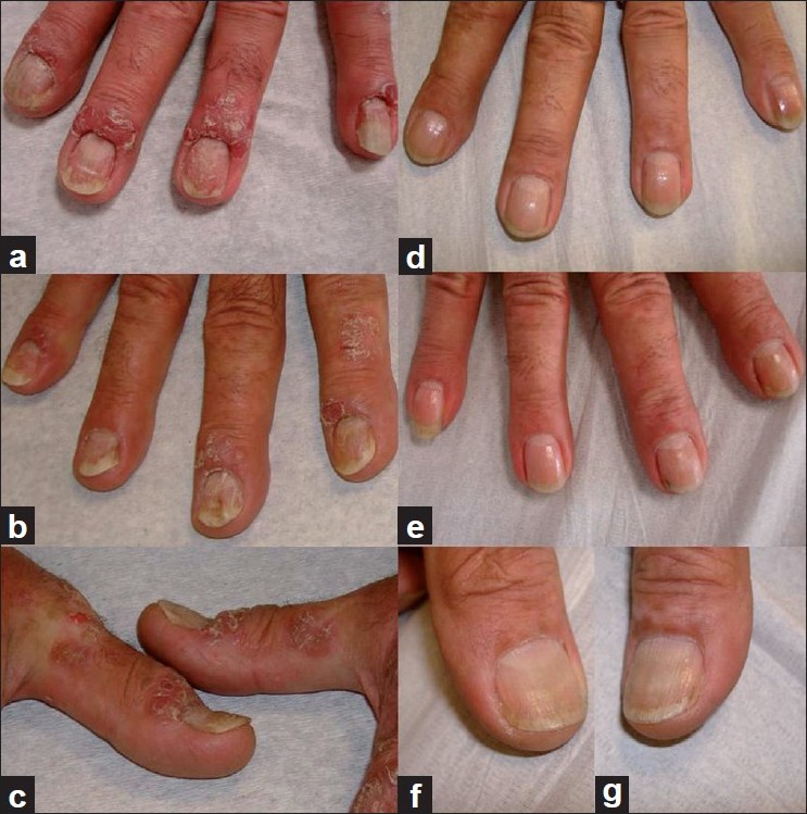 What's The Difference Between Nail Eczema And Nail Psoriasis?