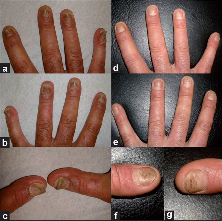 Successful and Rapid Treatment of Nail Psoriasis Using Topical Indigo  Naturalis Oil Extract | Semantic Scholar