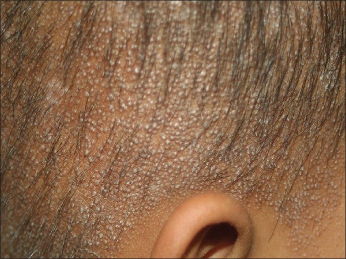 Follicular Hyperkeratosis Scalp