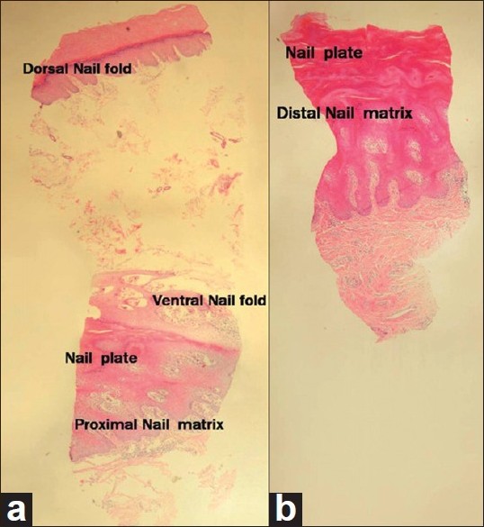 Proximal nail fold-lunula double punch technique: A less invasive method  for sampling nail matrix without nail avulsion - Indian Journal of  Dermatology, Venereology and Leprology