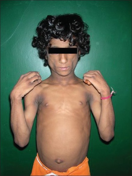 Indian Journal Of Dermatology Venereology And Leprology Congenital Generalized Lipodystrophy Of Berardinelli Seip Type A Rare Case