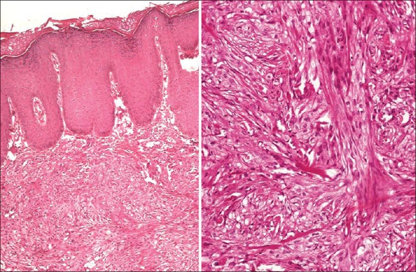 Multifocal Extra Ocular Sebaceous Carcinoma Indian Journal Of Dermatology Venereology And 