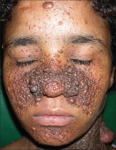 angiofibroma tuberous sclerosis