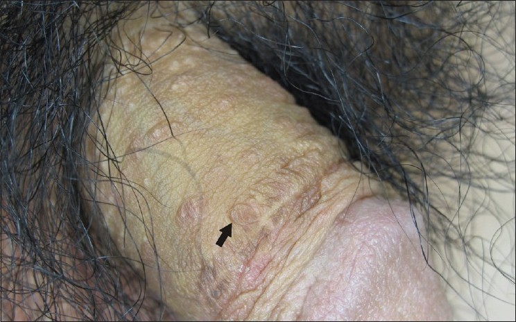 Multiple brownish papules on the penile shaft - Indian Journal of  Dermatology, Venereology and Leprology