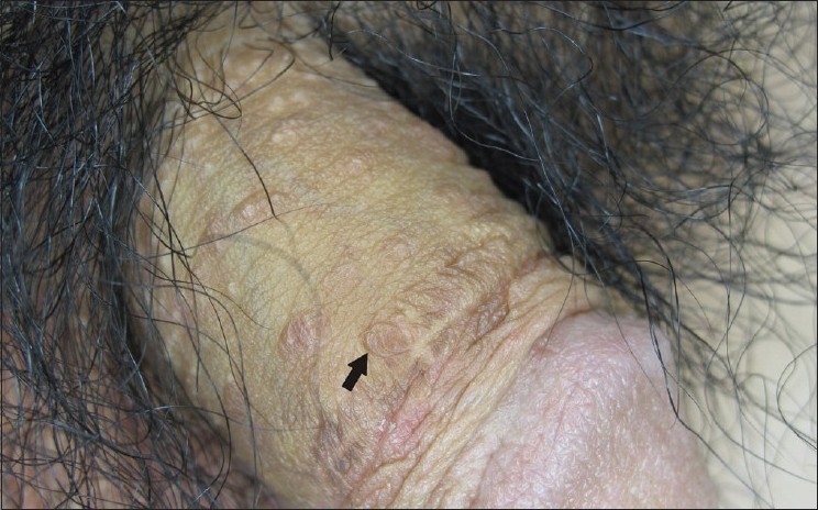 Multiple brownish papules on the penile shaft Indian Journal of