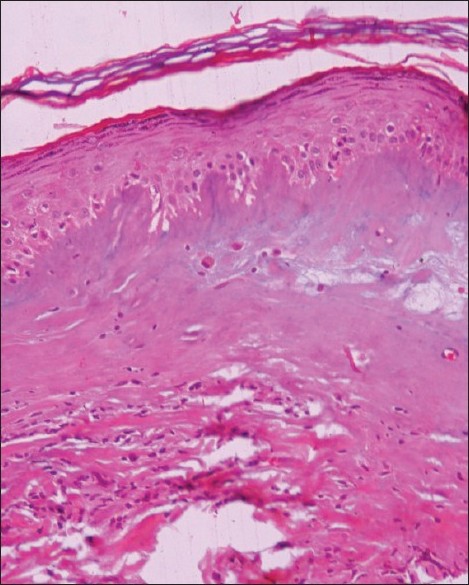 Lichen sclerosis clitoris