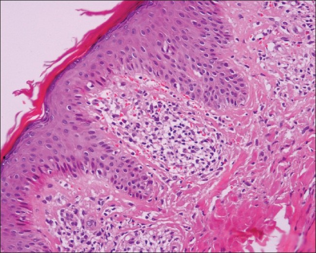 allergic contact dermatitis histology