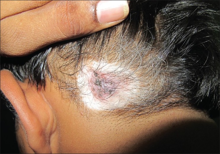 Halo nevus and 2025 vitiligo