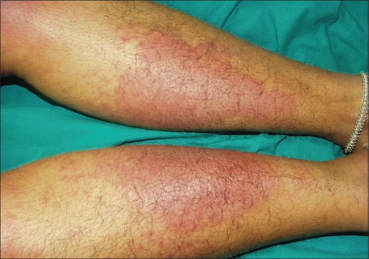 Contact Dermatitis Legs