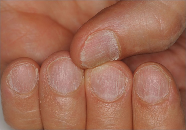 Onychorrhexis presenting as single longitudinal split of nail plate |  Download Scientific Diagram