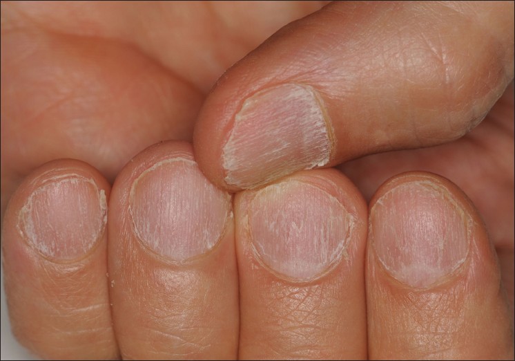 progress of green nails bacteria healing after one week (took off acrylics  from a salon that obviously wasn't hygienic). how much longer until i can  do my nails again?? : r/Nails