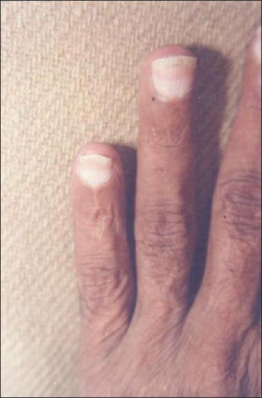 Nails in systemic disease - Indian Journal of Dermatology, Venereology and  Leprology