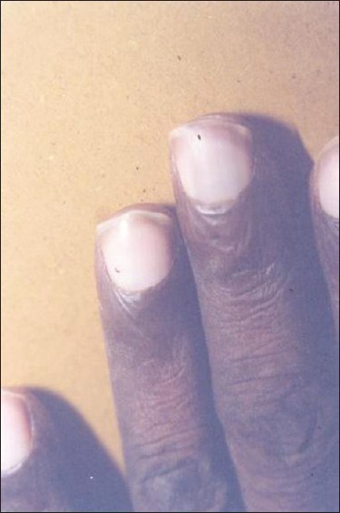 Terry's Nails: Pictures, Causes, Treatment, Vs. Lindsay's Nails