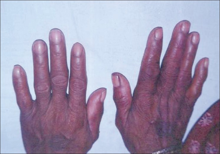 Smooth, diffuse thyroid swelling. Figure 2. Onycholysis (Plummer's nails).  | Download Scientific Diagram