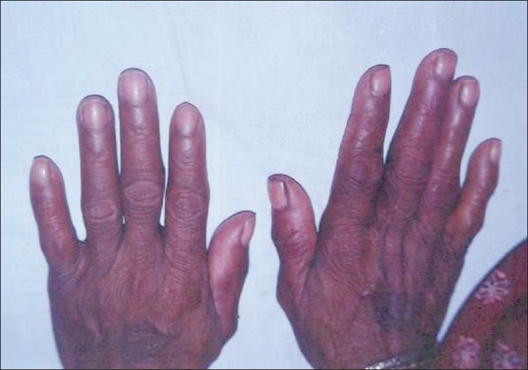 Figure: Periungual erythema of the proximal nail fold in an HIVinfected...  | Download Scientific Diagram