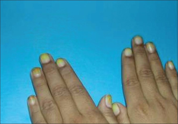 Structure of Nails And Nail Disorders