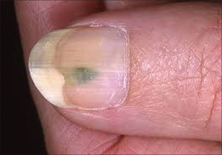 What you need to know about pseudomonas nail infections aka 