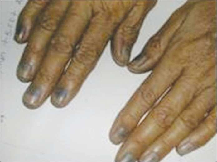 Nail dyschromias - Indian Journal of Dermatology, Venereology and Leprology
